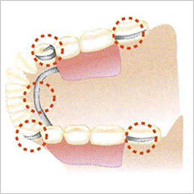 部分入れ歯の場合