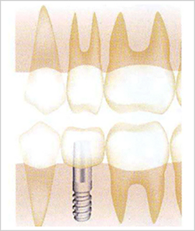 インプラント治療