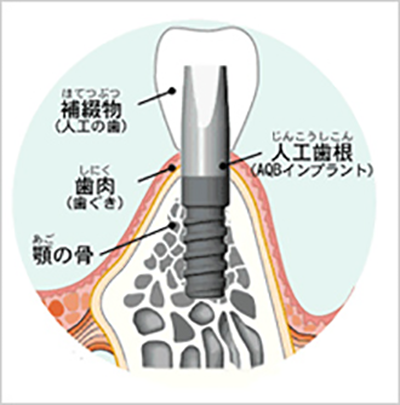 インプラント治療について