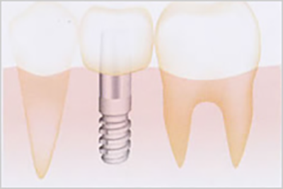 インプラント治療について